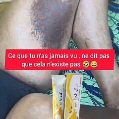 Crème – Anti-Mycoses, Tâches Noires et Boutons de Rasage