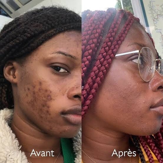 Savon anti - taches au curcuma | 100% Naturel