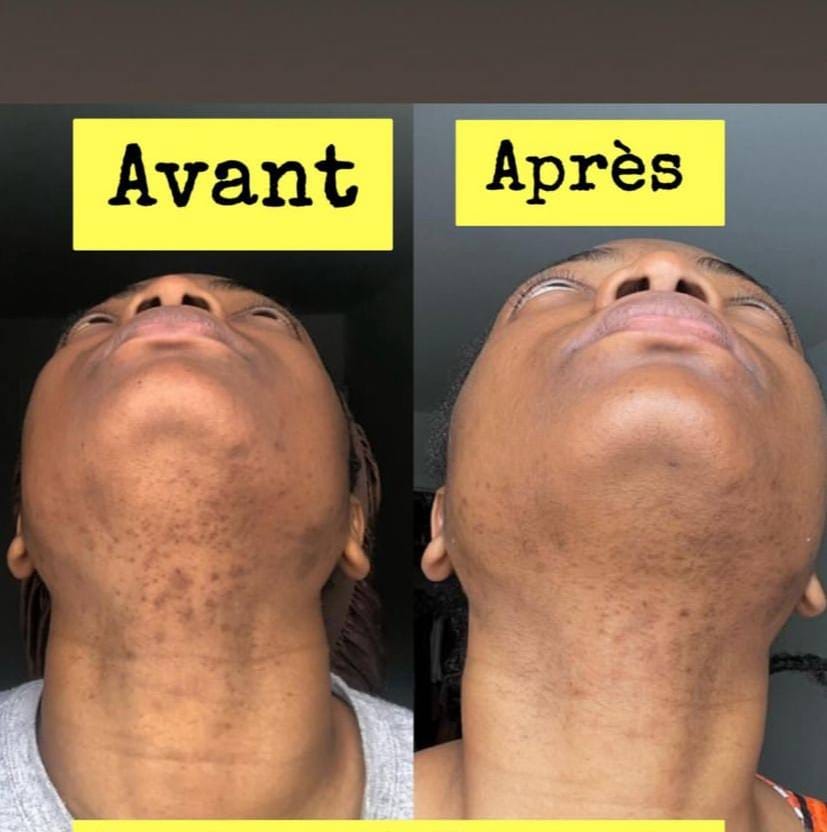 Savon anti - taches au curcuma | 100% Naturel