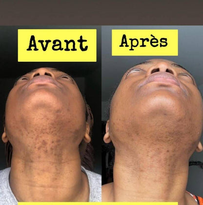 Savon anti - taches au curcuma | 100% Naturel
