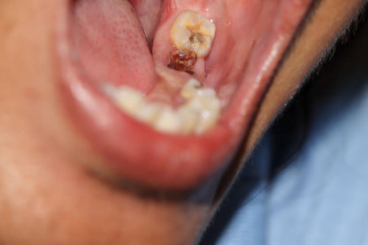 SPRAYDENTAIRE PRO : FINI LES DOULEURS DENTAIRES INSUPPORTABLES EN QUELQUES SECONDES