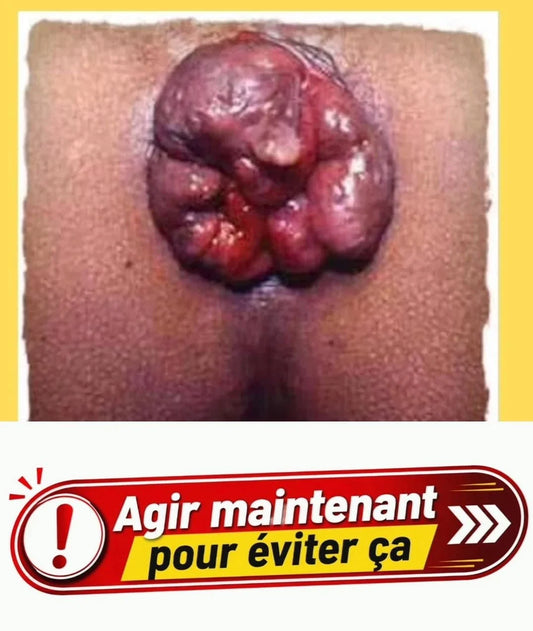 HEMOCALM™ Crème Apaisante pour Hémorroïdes, Démangeaisons , Brûlures & Inconfort Anal